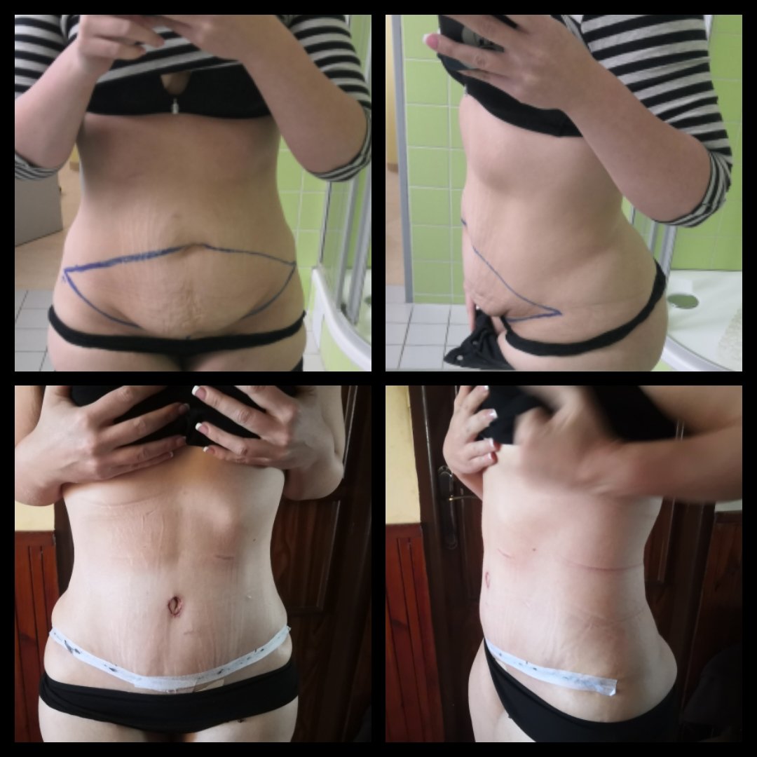 Paní Jitka před a po abdominoplastice Paní Jitka před a po abdominoplastice