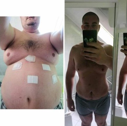 Pan Richard před a po operaci žaludku