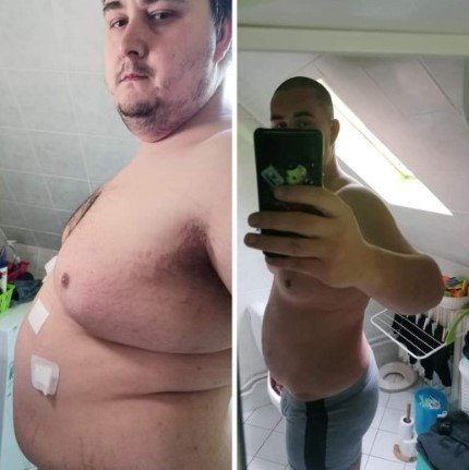 Rozhovor s Richardem o jeho zkušenosti s plikací žaludku
